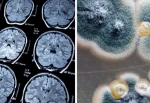 Mould, Bacteria And Alzheimers Mould and Alzheimers