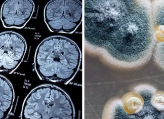 Mould, Bacteria And Alzheimers Mould and Alzheimers