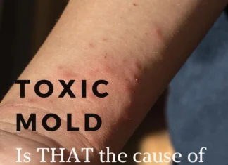 Mould, Bacteria And Skin Irritation Mould and Skin Irritation