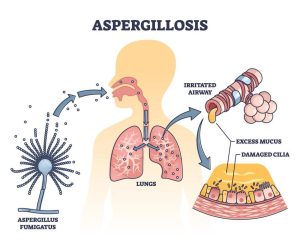 Respiratory Issues due to bacteria aspergillus